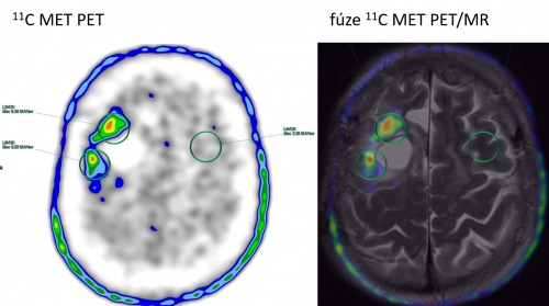 Užití radiofarmaka 11C-Methionin v praxi (vlevo vyšetření PET, vpravo vyšetření PET v kombinaci s MR)